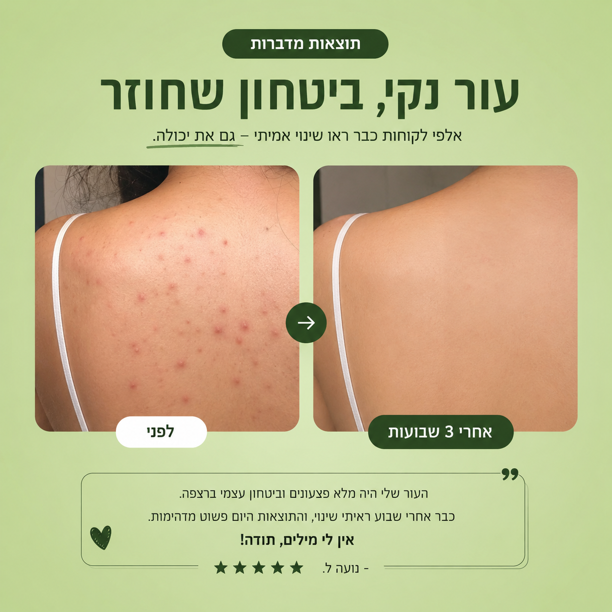 סבון טיפולי לאקנה בגב ובגוף