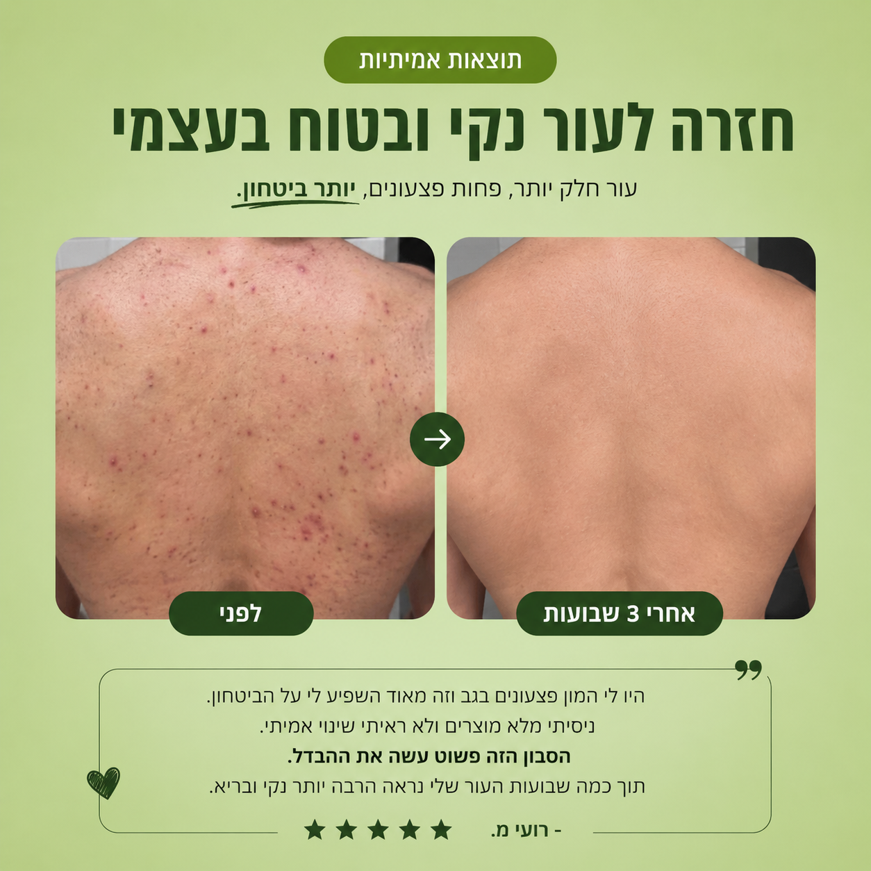 סבון טיפולי לאקנה בגב ובגוף