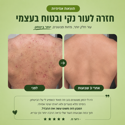 סבון טיפולי לאקנה בגב ובגוף